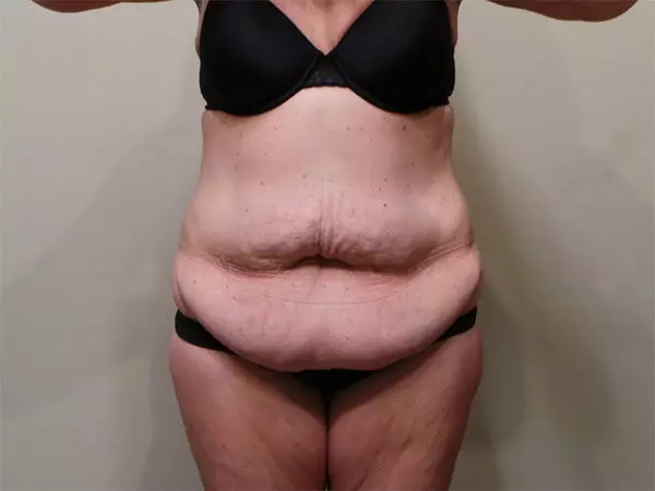 Tummy Tuck Patient 07 Before 1