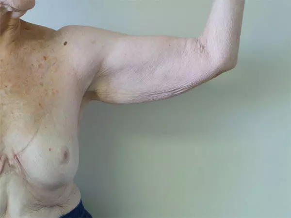 Arm Lift Patient 02 Before 1