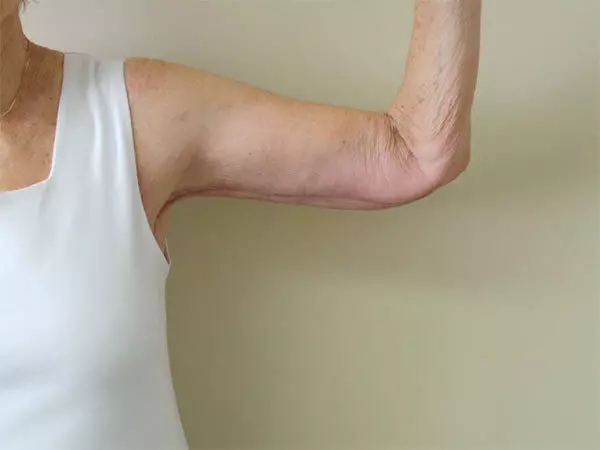 Arm Lift Patient 02 After 1