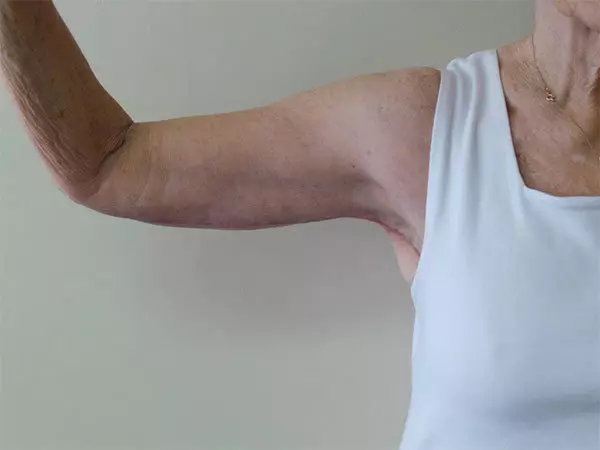 Arm Lift Patient 02 After 2