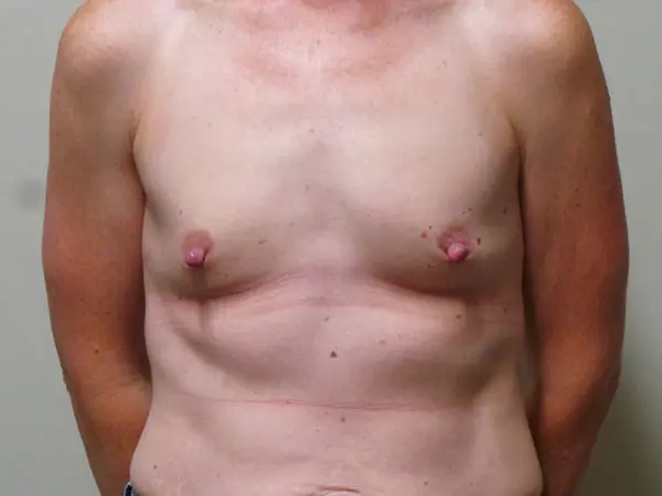 Breast Augmentation Patient 61 Before 1