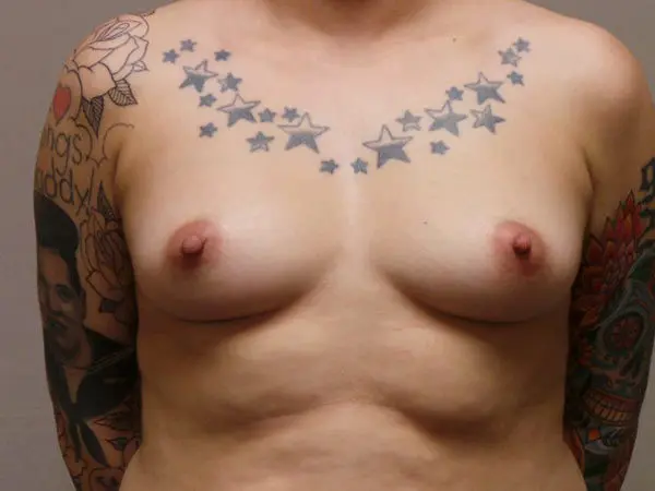 Breast Augmentation Patient 07 Before 1