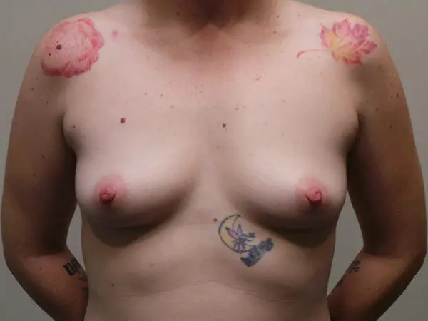 Breast Augmentation Patient 18 Before 1