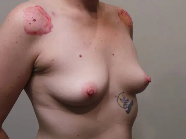 Breast Augmentation Patient 18 Before 2