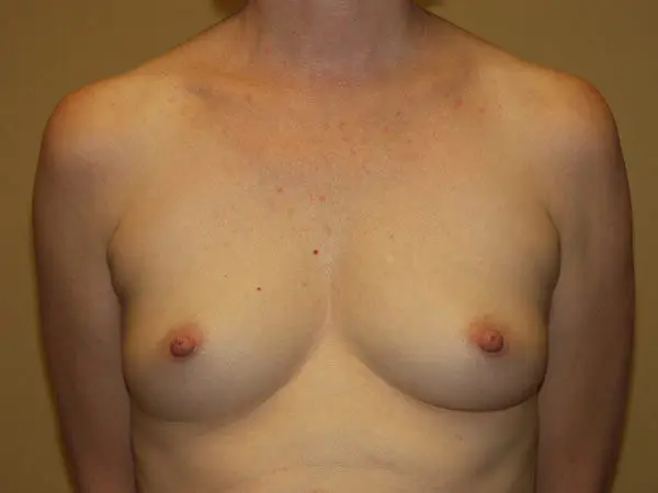 Breast Augmentation Patient 16 Before 1