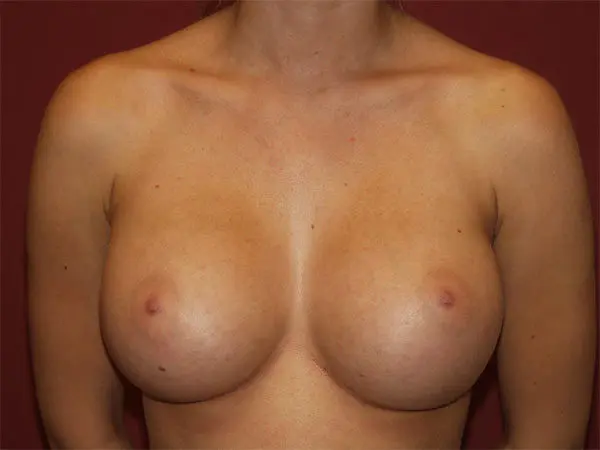 Breast Augmentation Patient 19 After 1