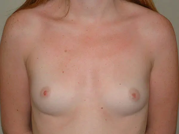 Breast Augmentation Patient 22 Before 1