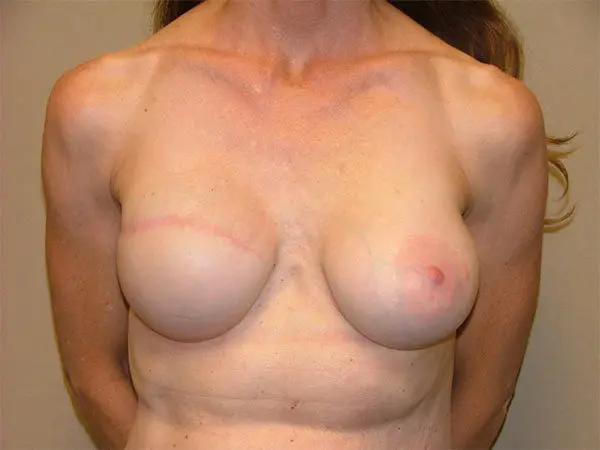 Breast Reconstruction Patient 01 After 1
