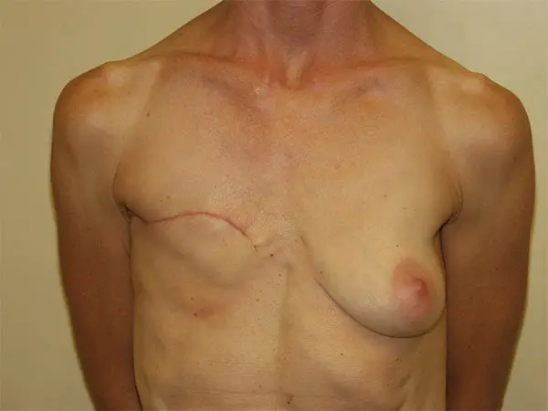 Breast Reconstruction Patient 01 Before 1