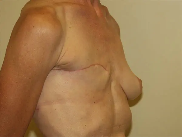 Breast Reconstruction Patient 01 Before 2