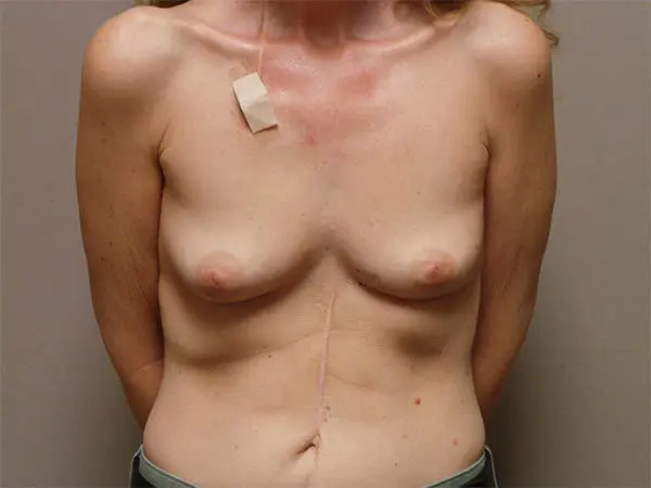 BREAST RECONSTRUCTION PATIENT 02 Before 1