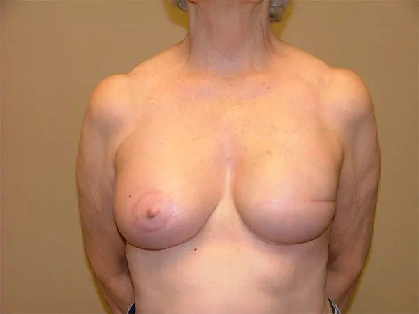 Breast Reconstruction Patient 03 After 1