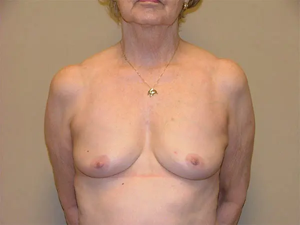 Breast Reconstruction Patient 03 Before 1
