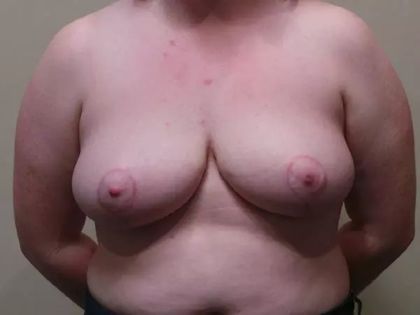 Breast Reduction Patient 03 After 1