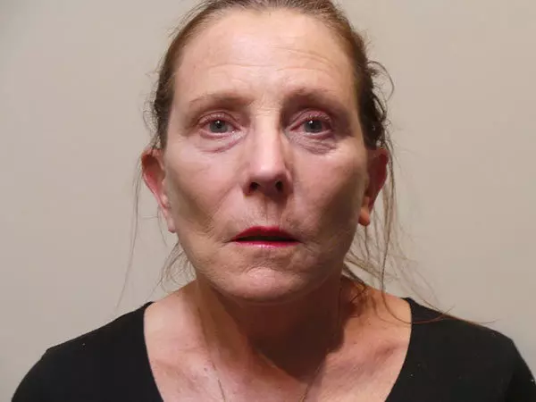 Brow Lift Patient 05 After 1