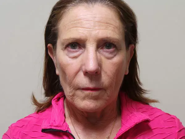 Brow Lift Patient 05 Before 1