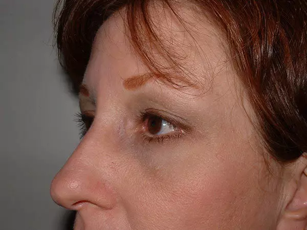Brow Lift Patient 01 After 2