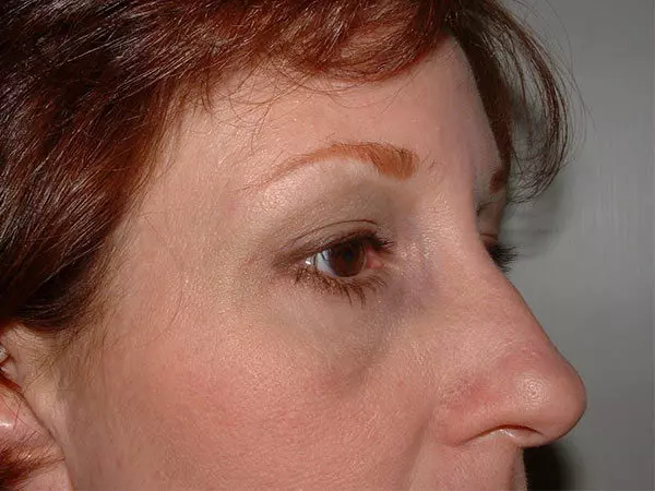 Brow Lift Patient 01 After 1