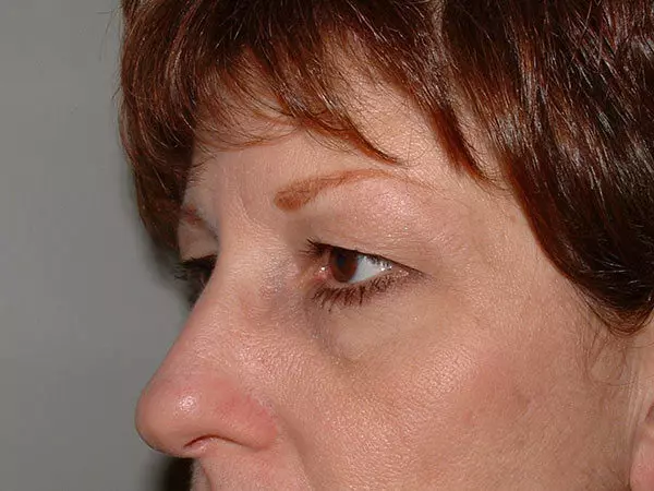 Brow Lift Patient 01 Before 2