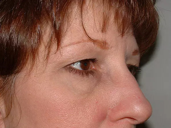 Brow Lift Patient 01 Before 1