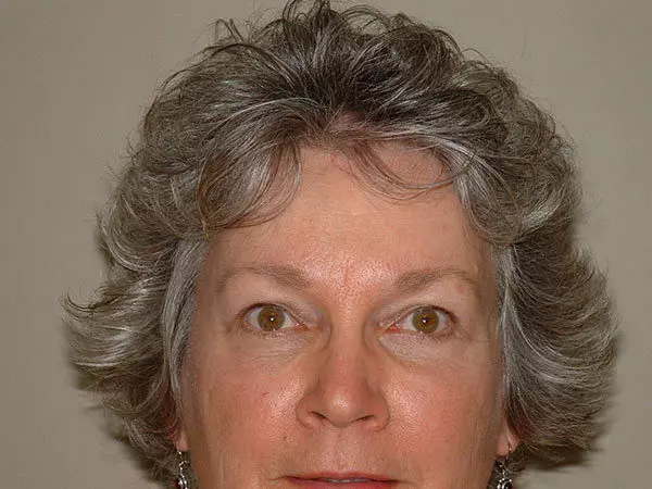 Brow Lift Patient 04 After 1