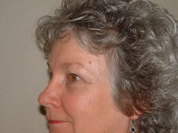 Brow Lift Patient 04 After 2