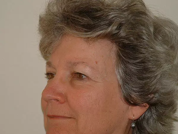 Brow Lift Patient 04 Before 2