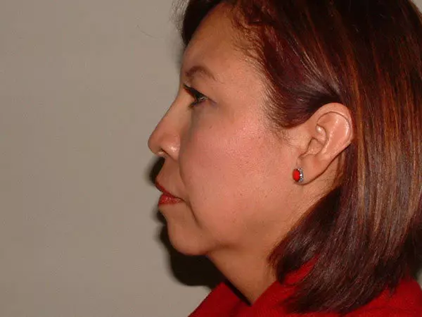 Brow Lift Patient 03 Before 2