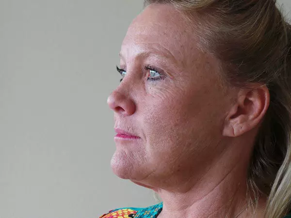 Brow Lift Patient 02 After 2