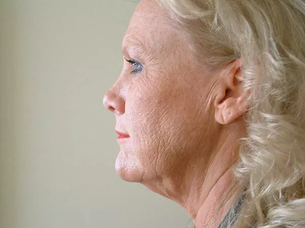 Brow Lift Patient 02 Before 1