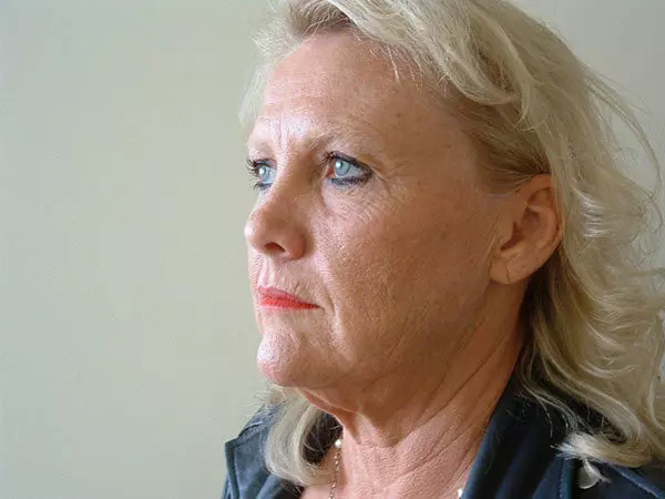 Brow Lift Patient 02 Before 2