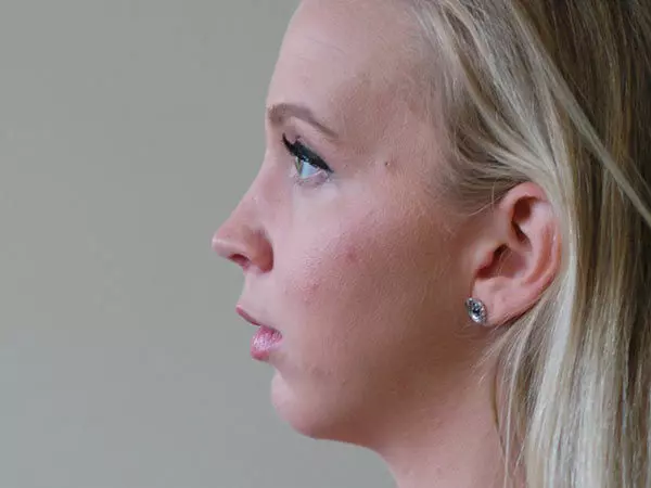 Chin Augmentation Patient 01 After 1