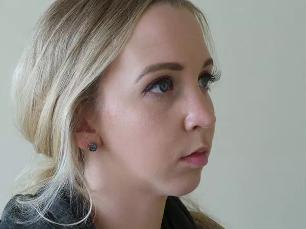 Chin Augmentation Patient 01 After 2