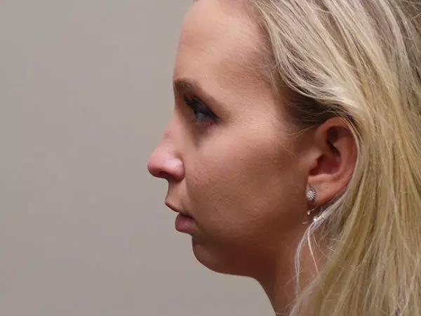 Chin Augmentation Patient 01 Before 1