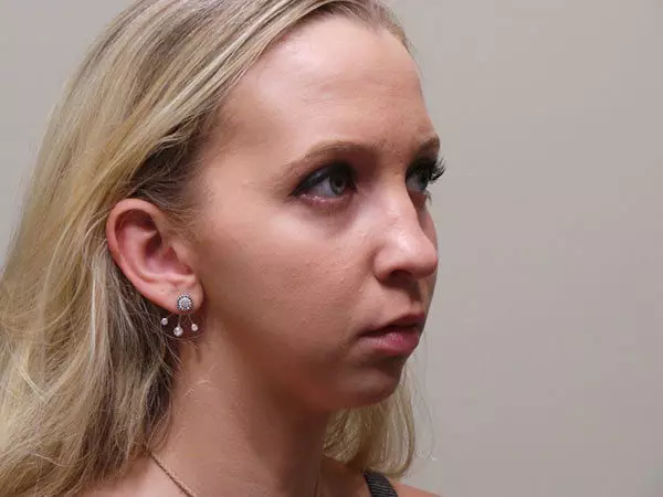 Chin Augmentation Patient 01 Before 2