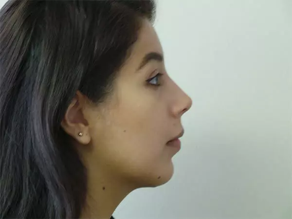 Chin Augmentation Patient 02 After 1