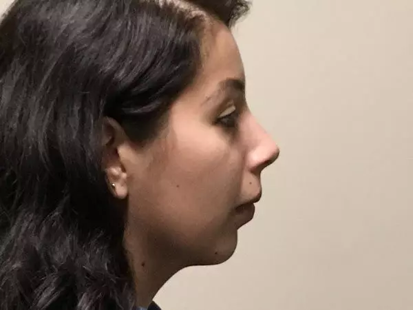 Chin Augmentation Patient 02 Before 1