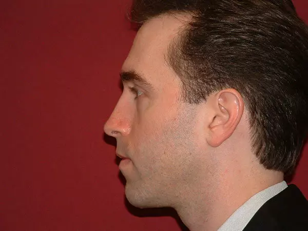 Chin Augmentation Patient 05 After 1