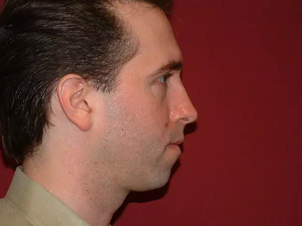 Chin Augmentation Patient 05 Before 2