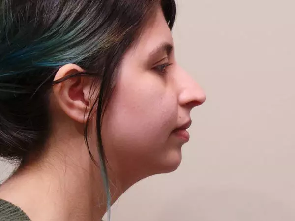 Chin Augmentation Patient 06 After 1
