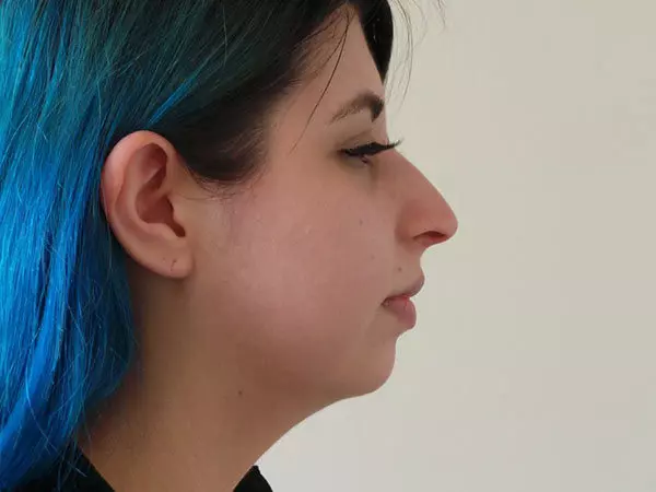 Chin Augmentation Patient 06 Before 1