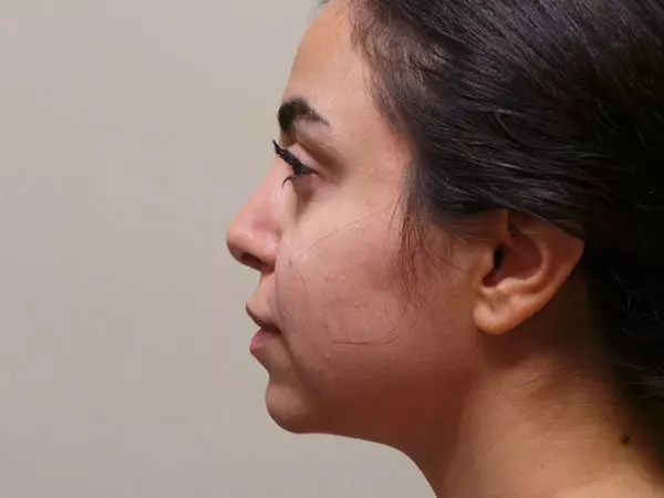Chin Augmentation Patient 03 Before 1