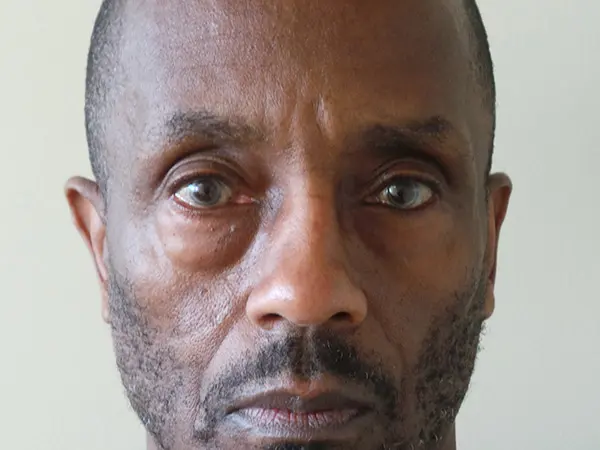 Eyelid Surgery Patient 23 Before 1