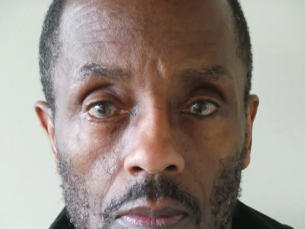 Eyelid Surgery Patient 23 After 1