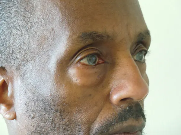 Eyelid Surgery Patient 23 Before 2