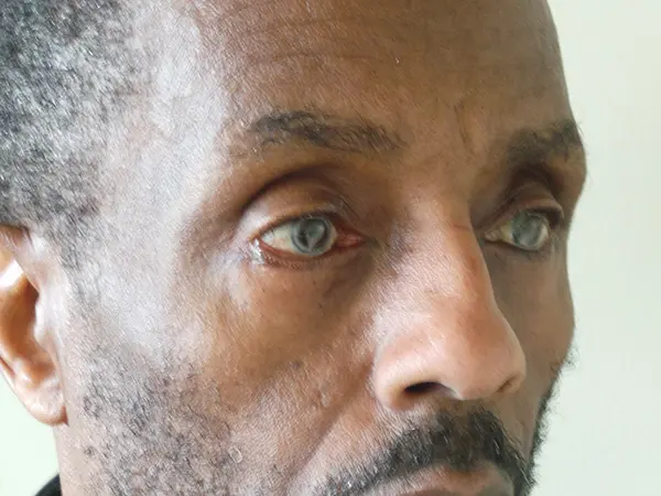 Eyelid Surgery Patient 23 After 2