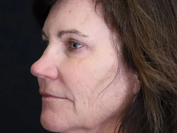 Eyelid Surgery Patient 24 After 1