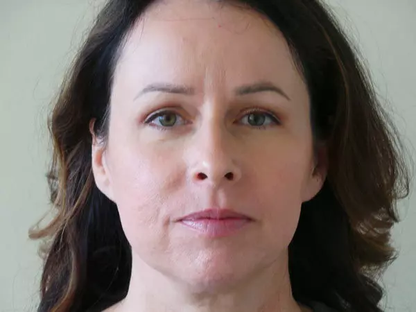 Eyelid Surgery Patient 01 After 2