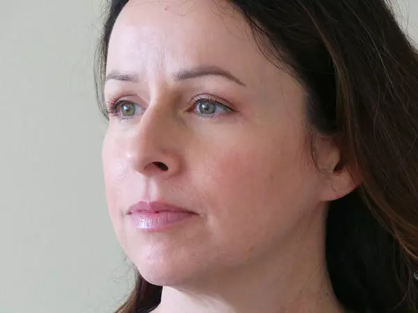 Eyelid Surgery Patient 01 After 1