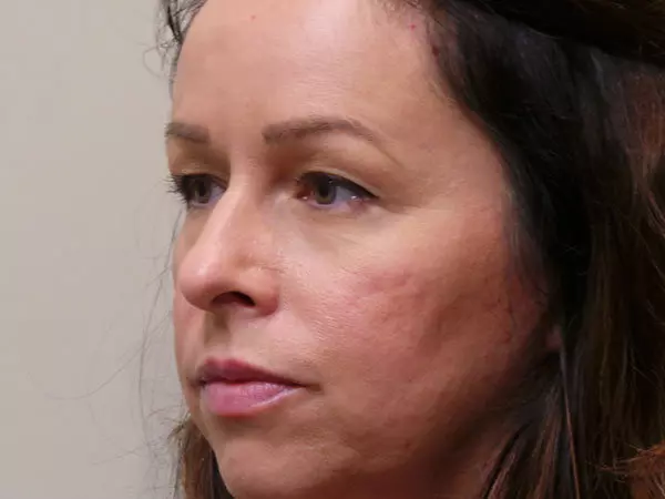 Eyelid Surgery Patient 01 Before 1